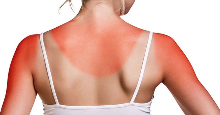 Quemaduras de sol – Cómo tratarlas y prevenirlas